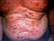 pitiriasis, enfermedad dermatologica que ataca a todo el cuerpo, provocada por un germen,llamado pitiriasis versicolor, hay tratamiento.