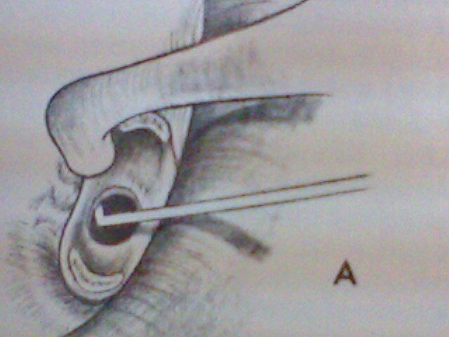 en este caso, ya se quito la supra estructura del estribo, se orto el nervio estapedial( es,el que da el gusto a los 2/3 anteriores de la lengua. Observen un orifico en el centro de l platina, 300x, donde se implantara , la prótesis.de Sylastic, acero, y 