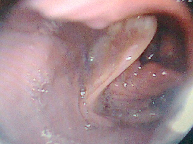 CPO EXTRAÑO EN LARINGE, ESTO ES VERDADERAMENE MILAGROSO, NO OBSTRUYO, LAS VÍAS RESPIRATORIAS, ESTA DEL LADO DERECHO, BAJO VISIÓN ENDOSCOPIA, MAGNIFICADO 400X.