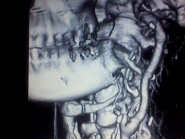 RESONANCIA MAGNETICA DEL CUELO,