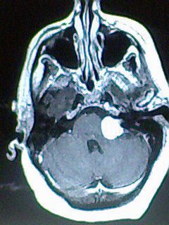 tomografia computarizada, (tac), demostrando un neurinoma del nervio acustico.
