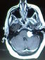 tomografia computarizada, (tac), demostrando un neurinoma del nervio acustico.