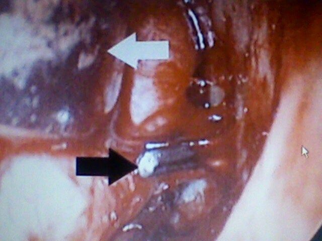 una arteria etmoidal clipada en negro, flecha blanca el ojo desplazado hacia adelante, , se visualiza el reborde orbitario, ojo derecho.de primera.HITEC