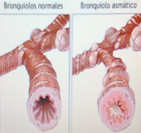 mucosa bronquial derecha normal izquierda con edema, igual que los cornetes.