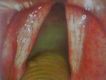 laringe normal ambas cuervas   vocales,vista 400x.
TODA PATOLOGÍA EN LARINGE CAUSA RONQUERA, DISFONIA.