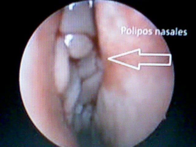 ENDOSCOPIA ENDONASAL, POLIPOSIS NASAL.