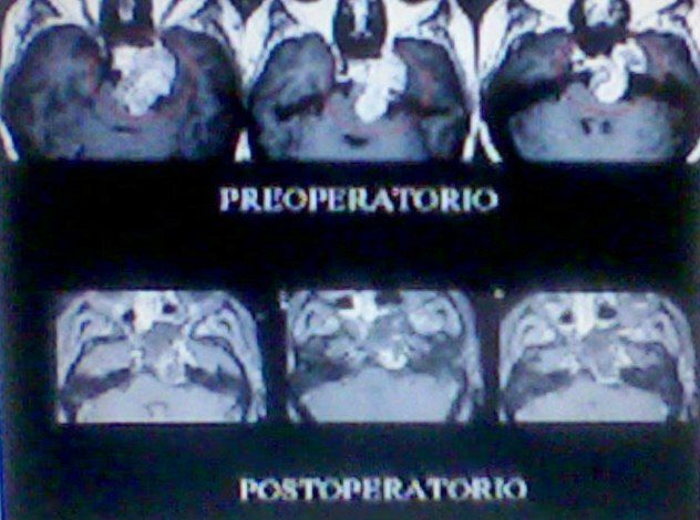 un caso de un neurinoma del acústico, o tumor de 8 avo par craneal, o par cocleovestibular, antes y después de la neurectomía, exitosa.